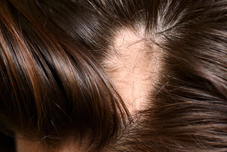 Is Hair Loss Reversible?